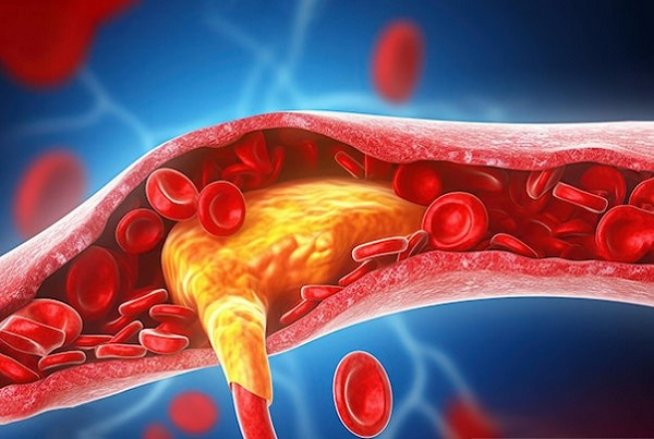 Dyslipidemia