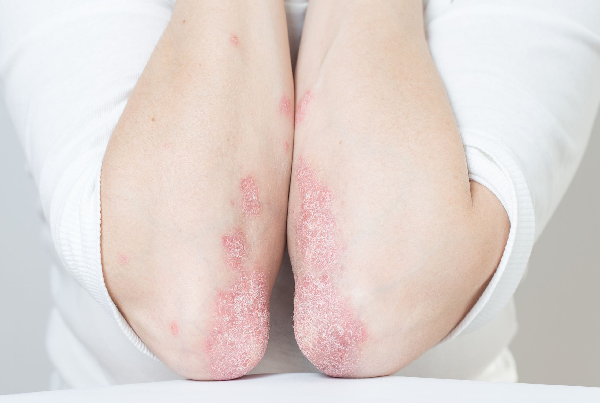 Autoimmune Disease